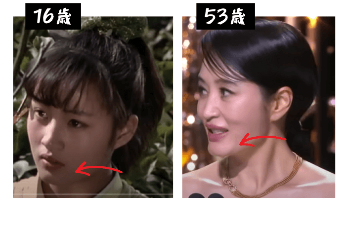 韓国女優キム・ヘス顎の変化の検証画像
16歳（左）写真
53歳（右）写真
顎の部分に矢印あり
明らかに顎がシャープになっている