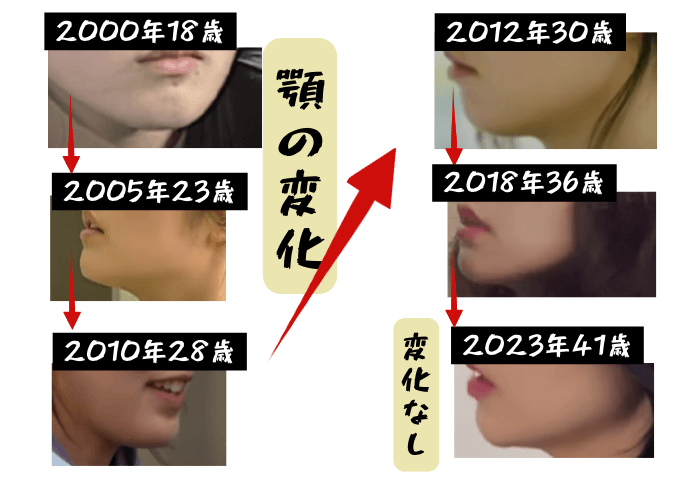 韓国女優ハン・ガインの顎の変化について検証画像
以下全6枚の画像

2000年18歳
2005年23歳
2010年28歳
2012年30歳
2018年36歳
2023年41歳