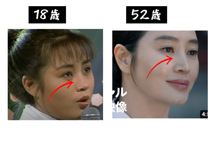 韓国女優キム・ヘス鼻の変化の検証画像
18歳（左）写真
52歳（右）写真
鼻の部分に矢印あり
明らかに高くなっている