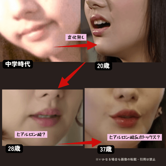 韓国女優パクミニョンの唇の変化について時系列検証画像
以下4枚の画像

中学時代（左上画像）
20歳（右上画像）
28歳（左下画像）
37歳（右下画像）

中学時代と20歳の唇には変化がない
28歳の唇はポッテリしていてヒアルロン酸注入の可能性がある
27歳の唇はポッテリした上に口角が引きつって上がっており、ヒアルロン酸注入とボトックス注入を行った可能性がある