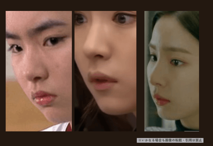 韓国女優シン・セギョンの上唇の画像３枚。
左側＝１４歳
中央＝２２歳
右側＝２７歳

シンセギョンの上唇は少し浮いていることがわかる